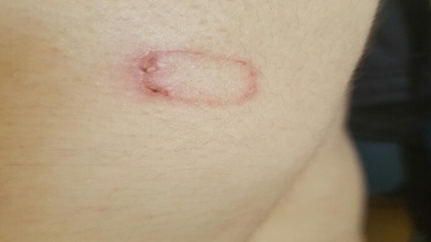 발열 화상화상.jpg