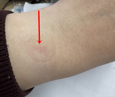 ▲스마트워치 착용 부위가 붉게 돼 있다